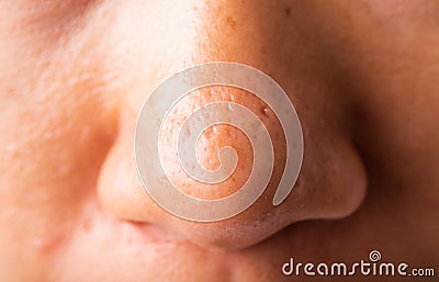 Woman large pores have freckles cheek oily, acne pimple on nose Stock Photo