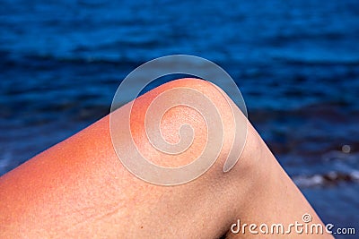 Woman leg with red sunburn skin on blue sea background. Sun burned skin redness and irritation Stock Photo