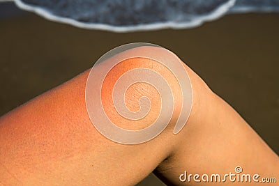 Woman leg with red sunburn skin on seaside background. Sunburned skin redness and irritation. Dangerous sun Stock Photo