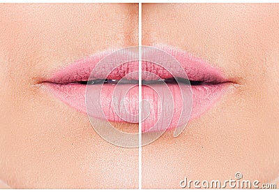 Woman lips before and after lip filler injections. Stock Photo