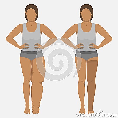 Woman with Lymphedema in Medical Compression Stocking Vector Illustration