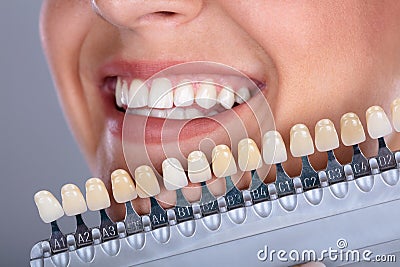 Woman Matching Shade Of The Implant Teeth Stock Photo