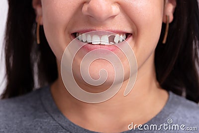Woman With Missing Tooth Stock Photo