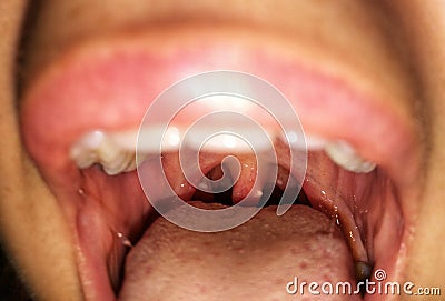 Woman with open mouth. Zooming closeup view of plaques with pus on tonsils gland in both sides Stock Photo