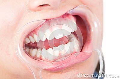 Woman patient with retractor standing with open mouth Stock Photo