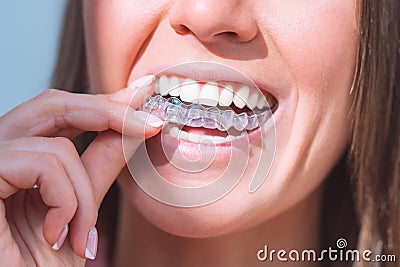 Woman with perfect smile wearing invisible dental aligners for dental correction Stock Photo