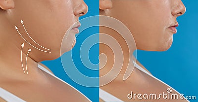 Woman before and after plastic surgery on blue background, closeup. Double chin problem Stock Photo