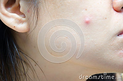 Woman pressing a pimple on her chick Stock Photo