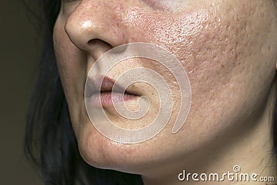 Woman with problematic skin and acne scars. Pigmentation on face woman. Problem skin care and health concept. Stock Photo