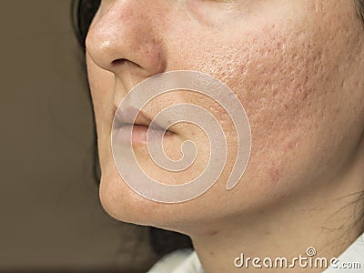 Woman with problematic skin and acne scars. Pigmentation on face woman. Stock Photo