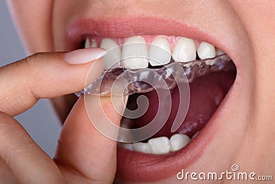 Woman Putting Transparent Aligner In Teeth Stock Photo