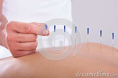 Woman receiving an acupuncture therapy Stock Photo