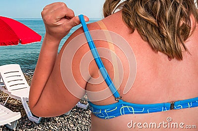 Woman with red sunburned shoulder - sunburn concept Stock Photo