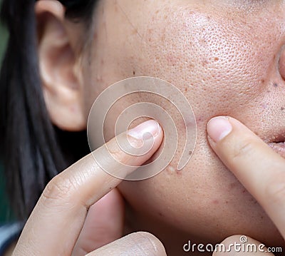 Woman`s problematic skin , acne scars ,oily skin and pore, dark spots and blackhead and whitehead on the face Stock Photo