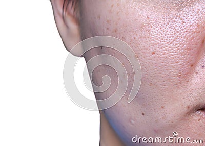 Woman `s problematic skin , acne scars ,oily skin and pore, dark spots and blackhead and whitehead on the face Stock Photo