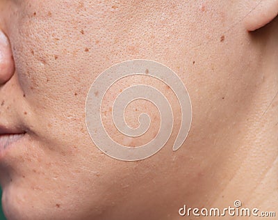 Woman `s problematic skin , acne scars ,oily skin and pore, dark spots and blackhead and whitehead on the face Stock Photo
