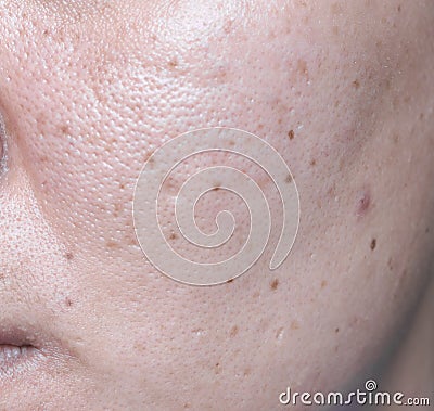 Woman`s problematic skin , acne scars ,oily skin and pore, dark Stock Photo
