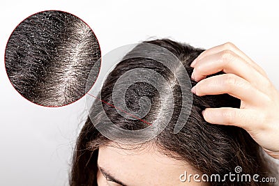 The woman scratches her head with her hand, showing a parting of dark hair with dandruff.Close up.The view from the top. White Stock Photo