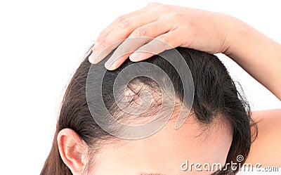 Woman serious hair loss problem for health care shampoo and beau Stock Photo