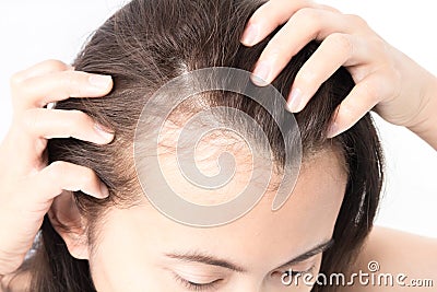 Woman serious hair loss problem for health care shampoo and beau Stock Photo