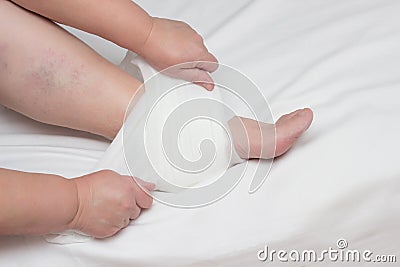A woman sets up a warming and anti-inflammatory compress on the heel with heel spurs, plantar fasciitis, close-up Stock Photo