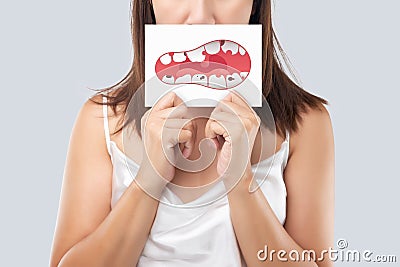 Decayed tooth Stock Photo