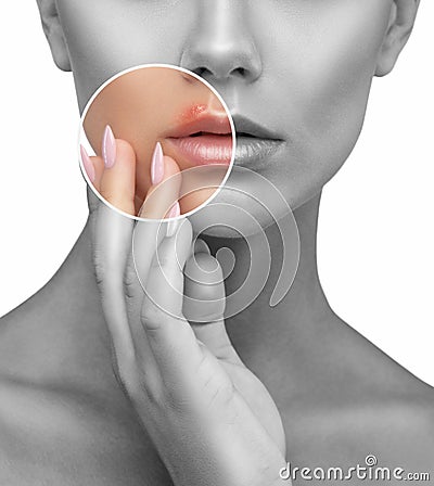 Woman showing herpes disease on her lips. Treatment of viral infections Stock Photo