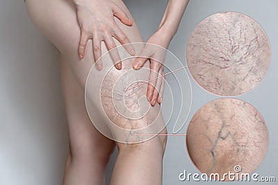 Woman shows leg with varicose veins. Magnifying the image. The concept of human health and disease Stock Photo