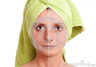 Woman with spotty skin healed Stock Photo