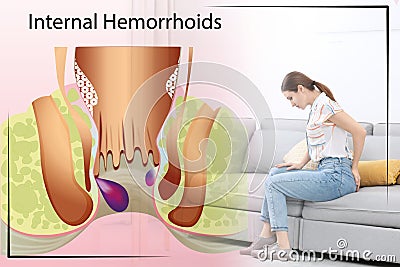 Woman suffering from hemorrhoid pain on sofa at home. Illustration of unhealthy lower rectum Stock Photo