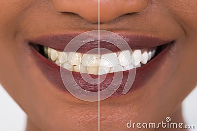 Woman Teeth Before And After Whitening Stock Photo