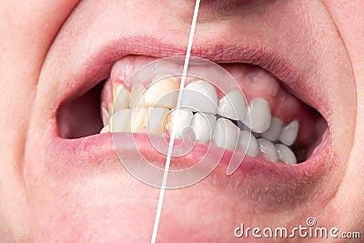 Woman teeth before and after whitening. Dental health concept. Stock Photo