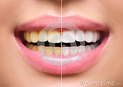 Woman teeth before and after whitening Stock Photo