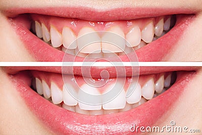 Woman teeth before and after whitening. Over white background. Dental clinic patient. Image symbolizes oral care Stock Photo