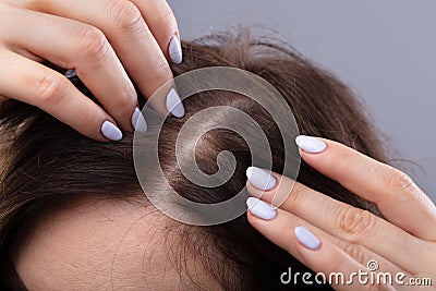 Woman With Thinning Hair Stock Photo
