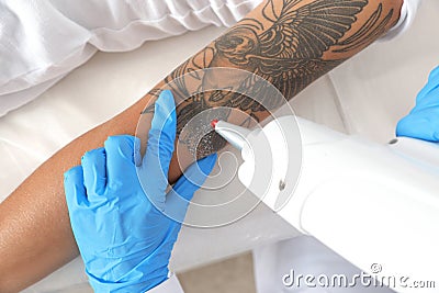 Woman undergoing laser tattoo removal procedure Editorial Stock Photo