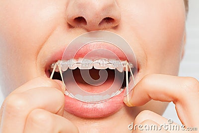 Close-up of woman wearing orthodontic elastic band Stock Photo