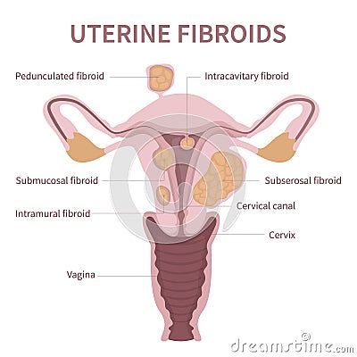 Woman uterine fibroids diagram on white background Vector Illustration