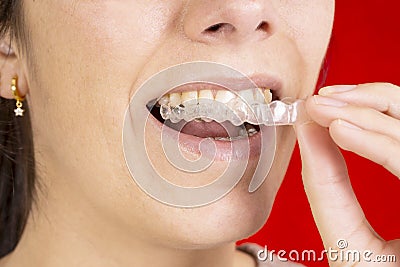 Woman wearing orthodontic silicone corrector. Invisible braces aligner. Stock Photo