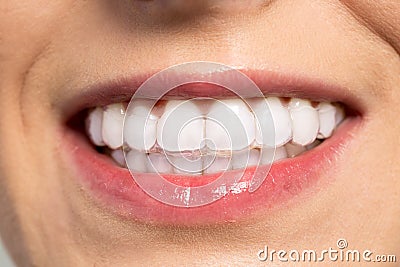 Woman wearing orthodontic silicone trainer Stock Photo