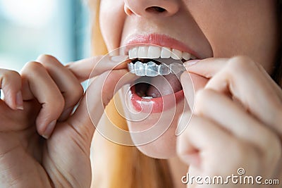 Woman wearing orthodontic silicone trainer. Invisible braces aligner Stock Photo