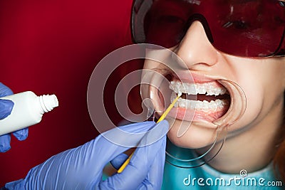 Woman whitening teeth Stock Photo