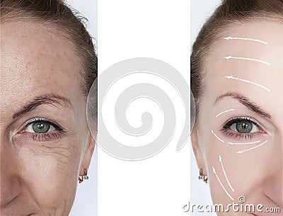 Woman wrinkles correction lifting contrast results before and after treatments arrow Stock Photo