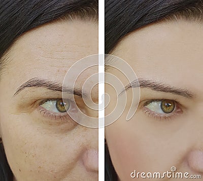 Woman difference wrinkles beautician health pigmentation face patient before and after lifting cosmetic procedures contrast Stock Photo