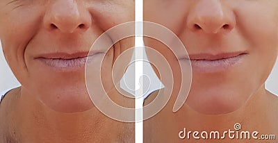 Woman wrinkles on face dermatology before and after health anti-aging procedures Stock Photo