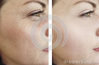 Woman wrinkles face beautician effect therapydifference regeneration before and after treatments Stock Photo