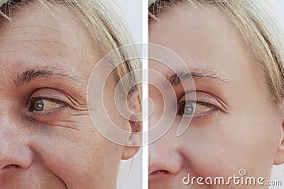 Woman wrinkles on face concept before and after patient injection anti-aging procedures Stock Photo