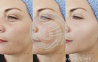 Woman wrinkles face results arrow collage lifting contour tension before and after contrast treatment Stock Photo