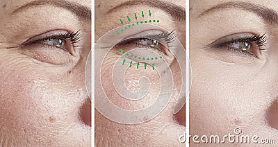 Woman wrinkles swollen removal lifting blepharoplasty therapy contrast before treatment difference sagging correction Stock Photo
