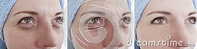 Woman wrinkles face arrow collage lifting contour tension before and after contrast treatment Stock Photo